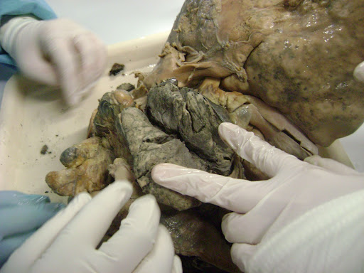 "Pictures of ganglion cyst on foot, ganglion cysts and dogs